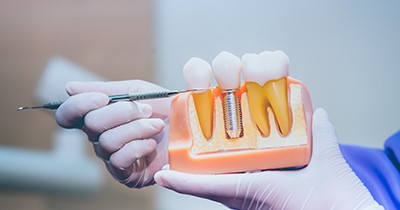Dentist pointing to a dental implant model