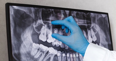 dentist pointing to an X-ray of a mouth